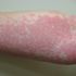 Pictured: Skin rash which is ‘fourth symptom of COVID-19’